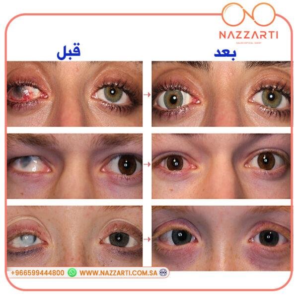 عدسات لاصقة تجميلية